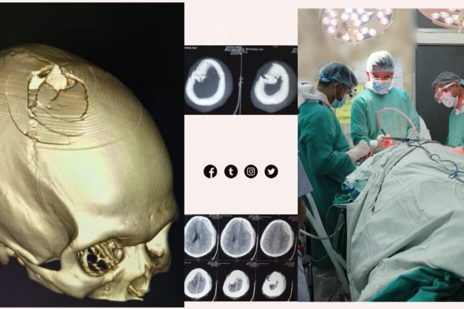 Depressed Midline Skull Fracture with EDH Treatment in Indore