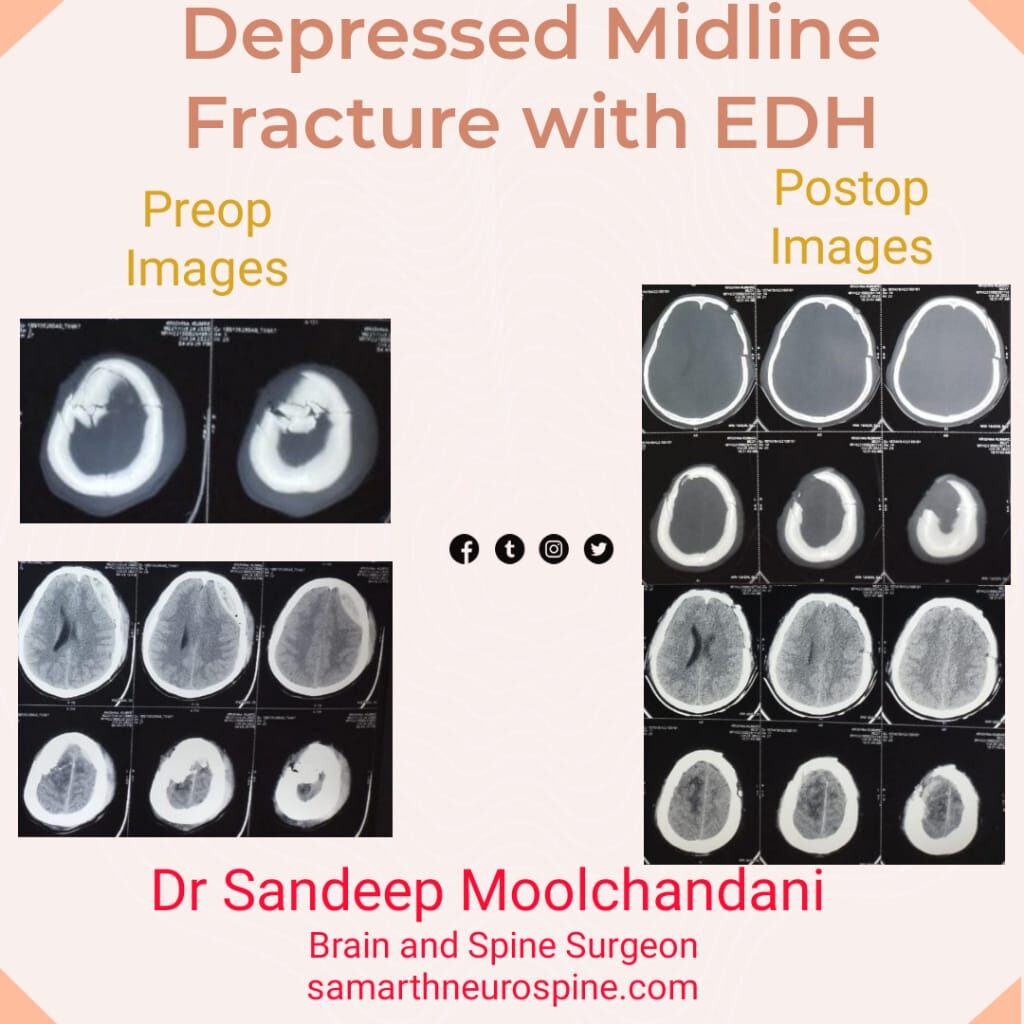 Depressed Midline Skull Fracture with EDH Treatment in Indore