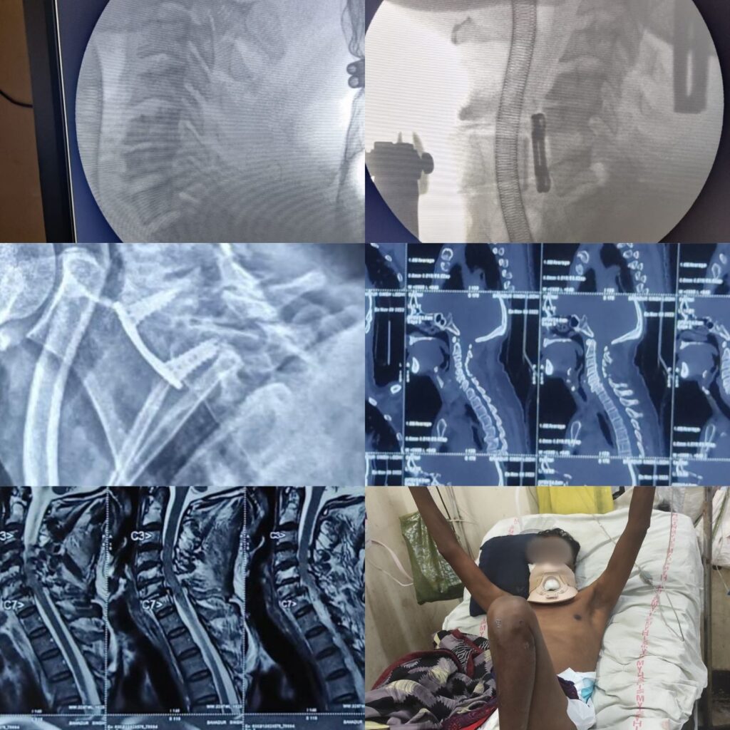 Surgery for fracture of Neck (Anterior Cervical Discectomy and Fusion) - Dr. Sandeep Moolchandani (Brain and Spine Surgeon, Indore)
Neurosurgeon/ Neurologist in Indore