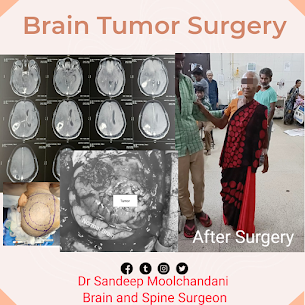 Best Neurosurgeon/ Neurologist in Indore