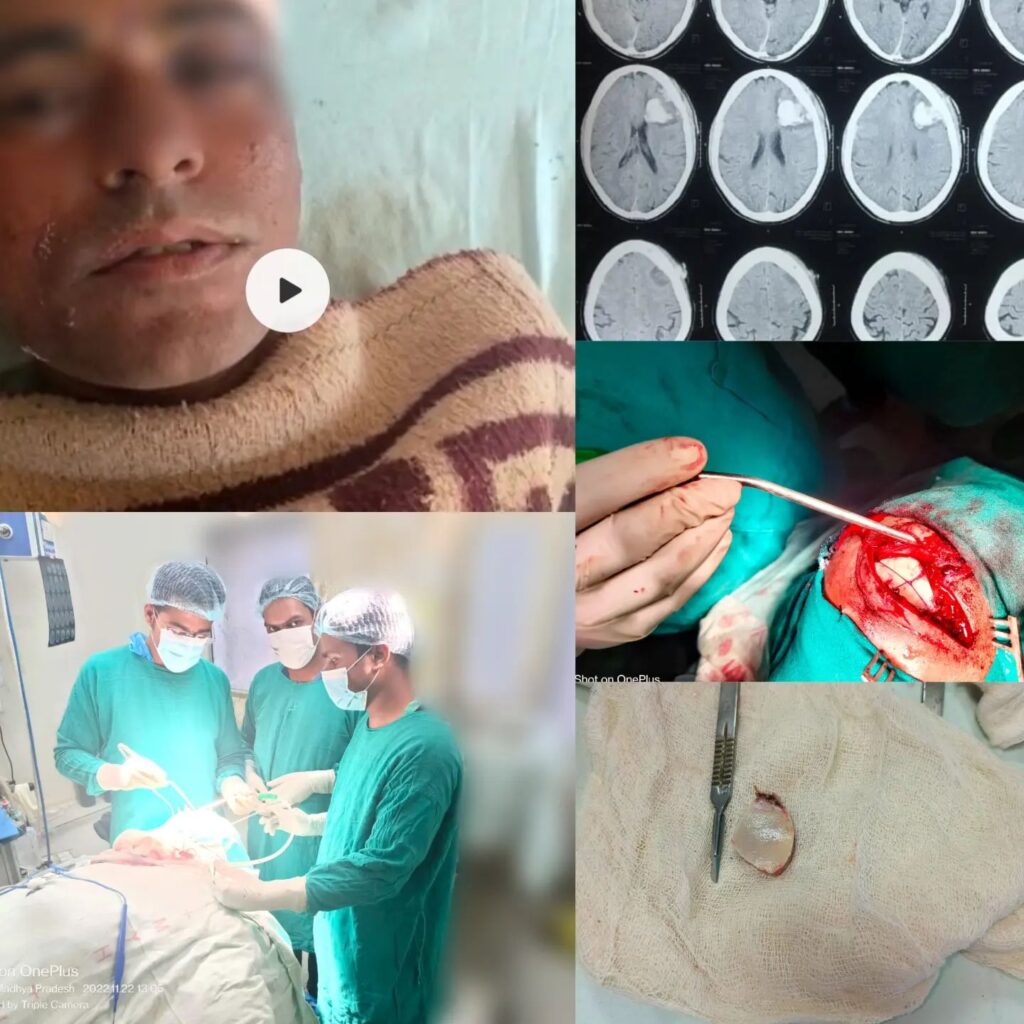 Mini Craniotomy or Key Hole Craniotomy and Brain Hemorrhage Removal - Dr. Sandeep Moolchandani (Brain and Spine Surgeon, Indore)