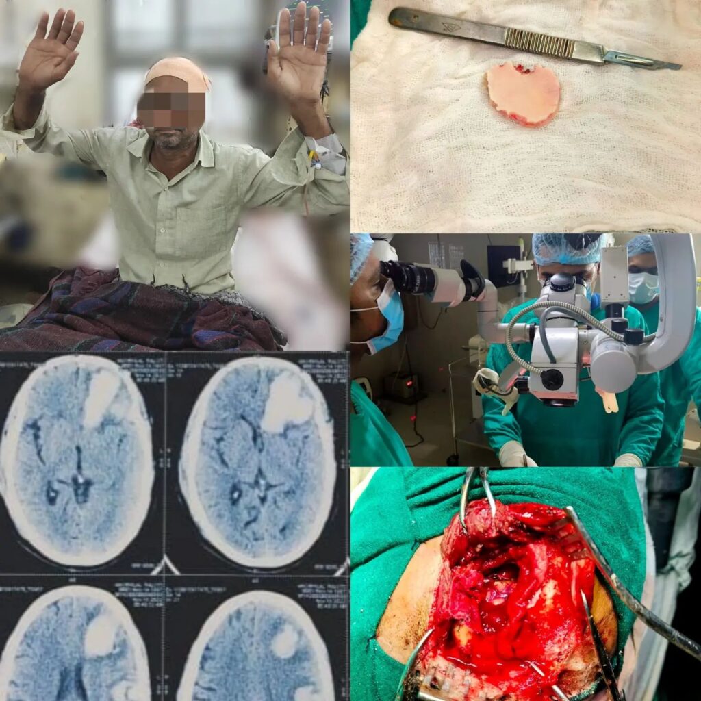 Key Hole Craniotomy or Mini Craniotomy and Brain Contusion Removal. Patient neurologically preserved. - Dr. Sandeep Moolchandani                                  (Brain and Spine Surgeon, Indore)