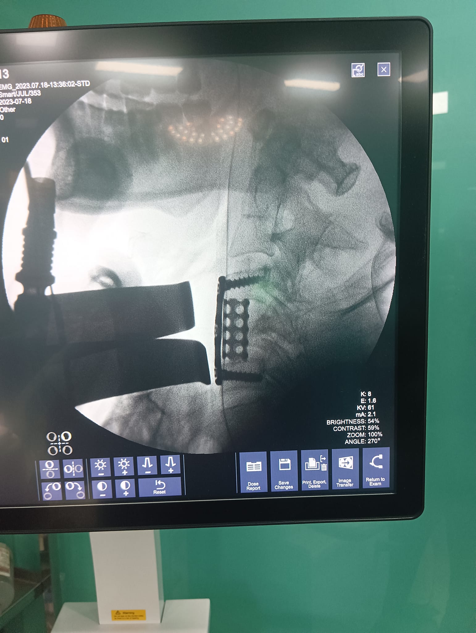 cervical corpectomy treatment by best spine surgeon in indore