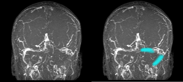 Cerebral Venous thrombosis