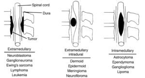 Spine Tumor Surgery in Indore Spine Tumor Treatment in Indore