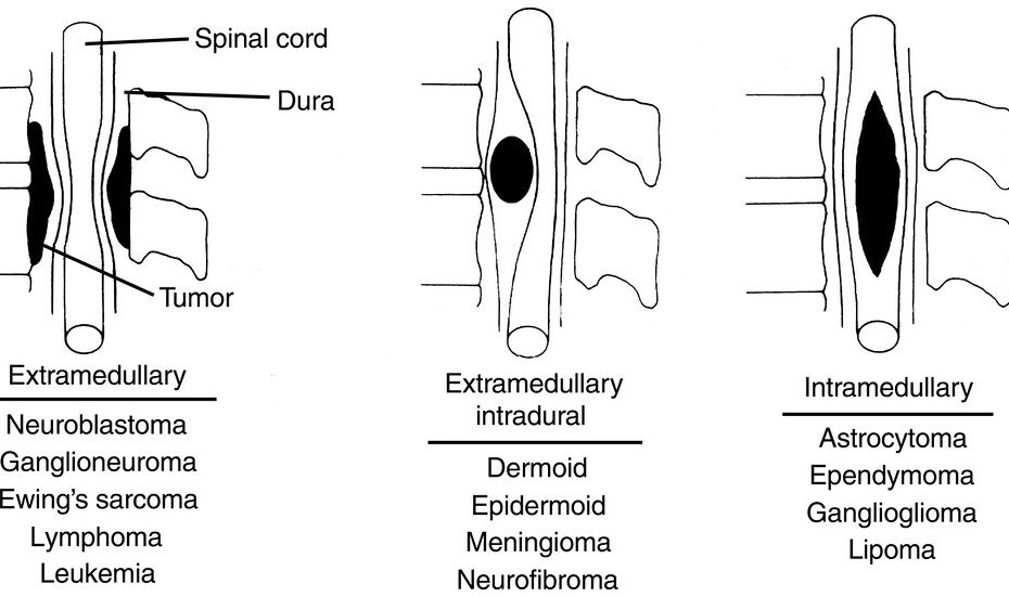 Spine Tumor Surgery in Indore Spine Tumor Treatment in Indore