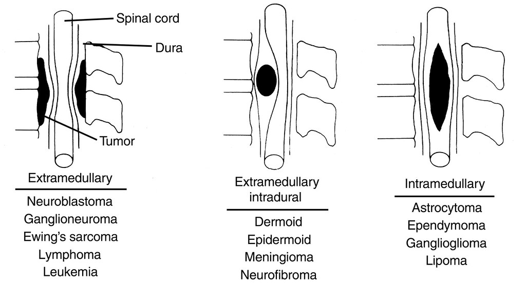 Spine Tumor Surgery in Indore Spine Tumor Treatment in Indore