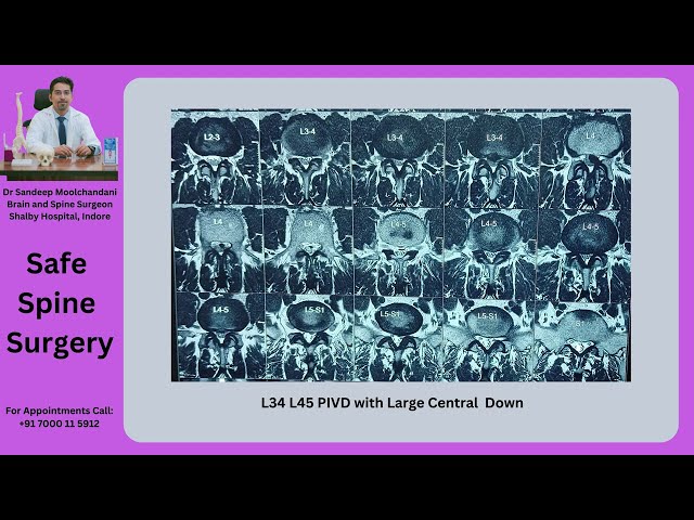 Spine Surgery For Disc Prolapse