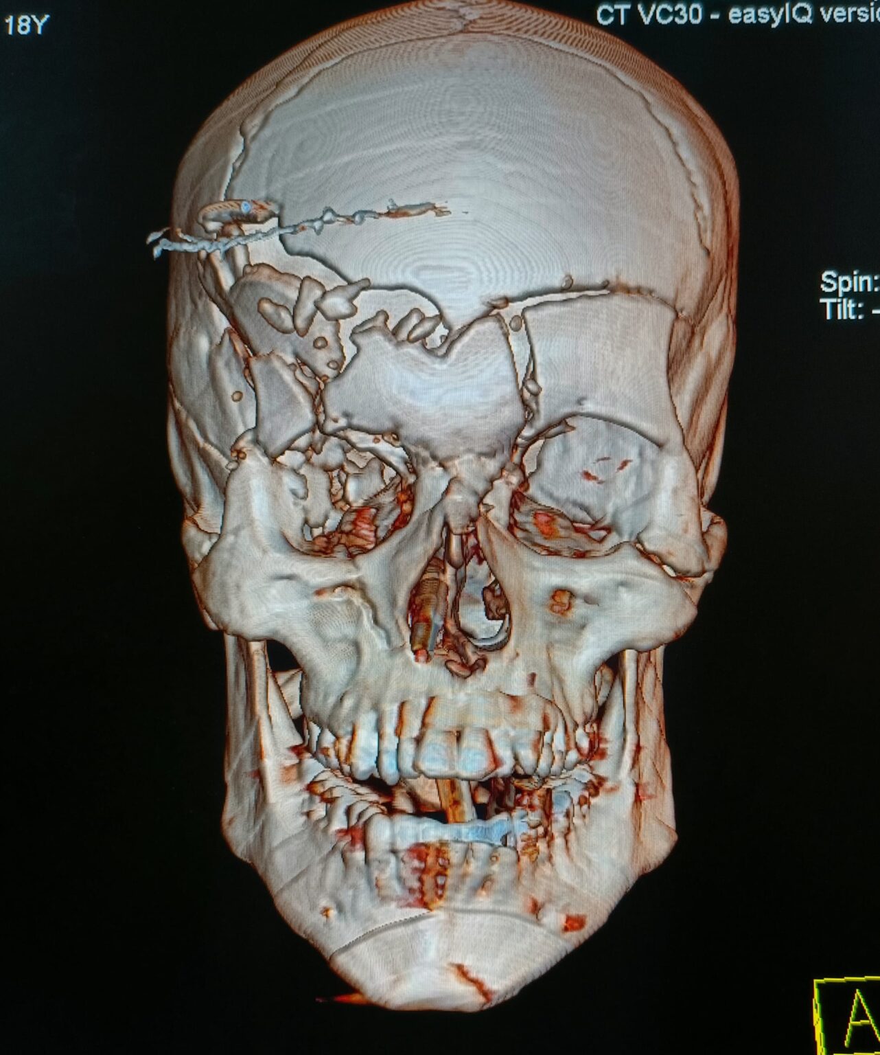 Head Injury Treatment in Indore, Skull Fracture Treatment in Indore