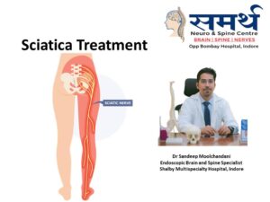 Sciatica Treatment in Indore