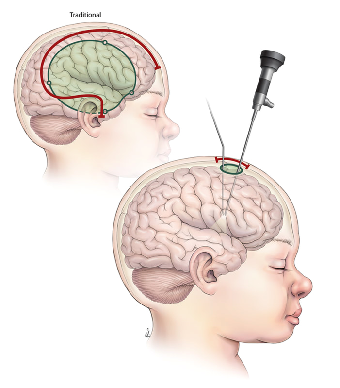 Endoscopic Brain Surgery